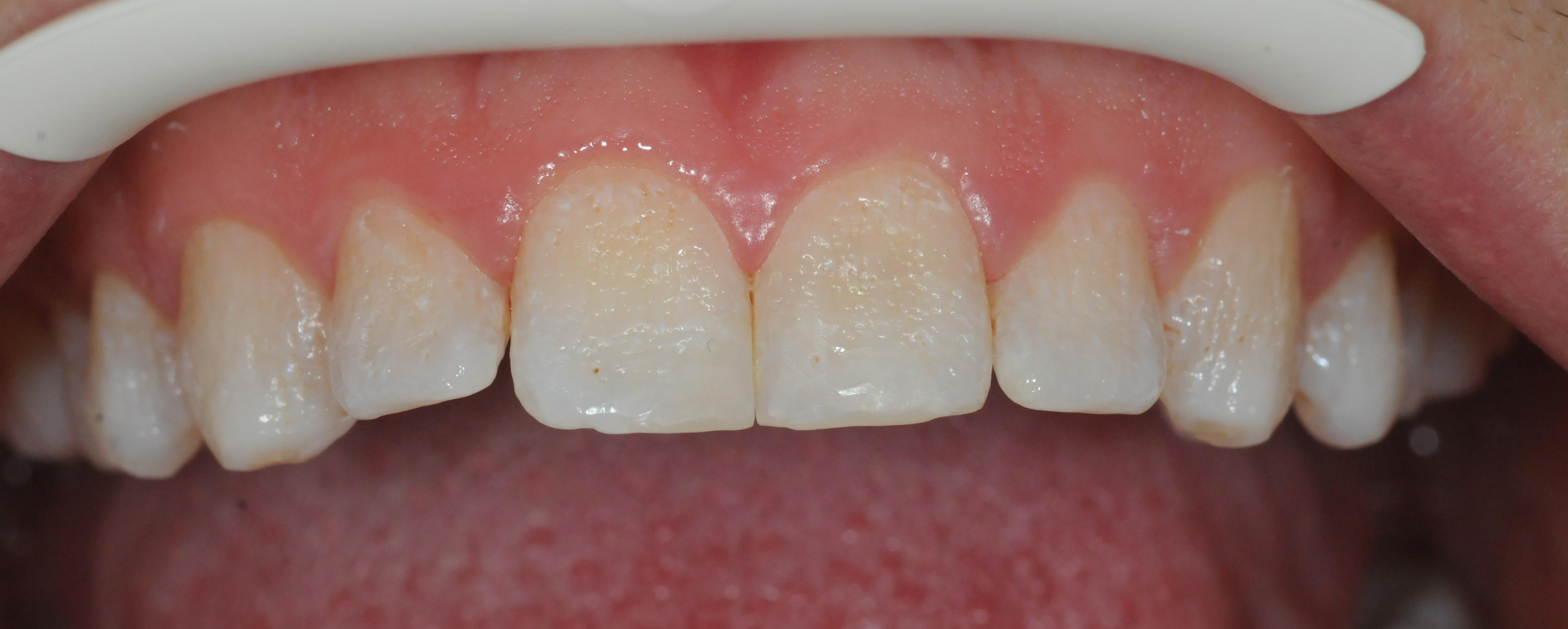 Amelogenesis imperfecta.jpg